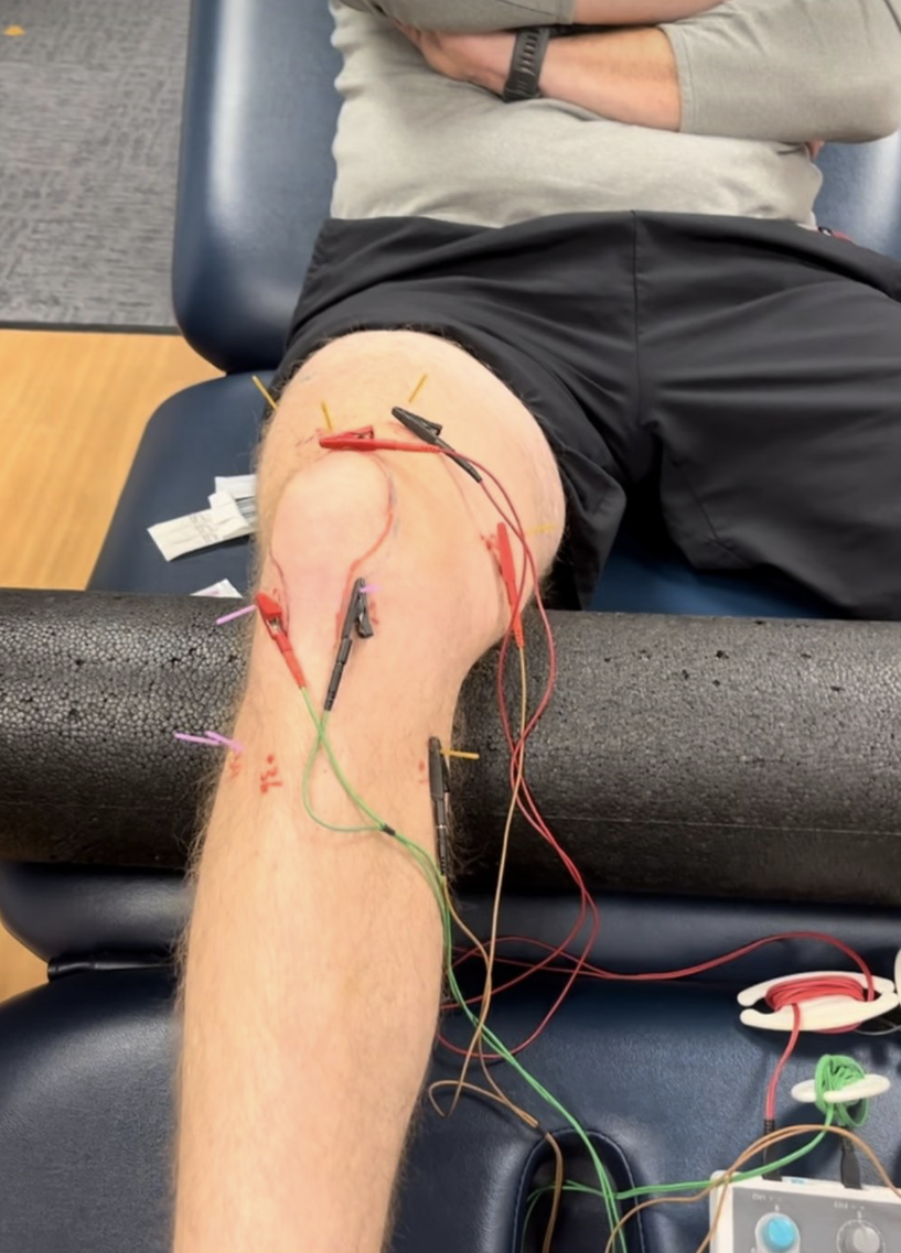 Dry Needling Knee